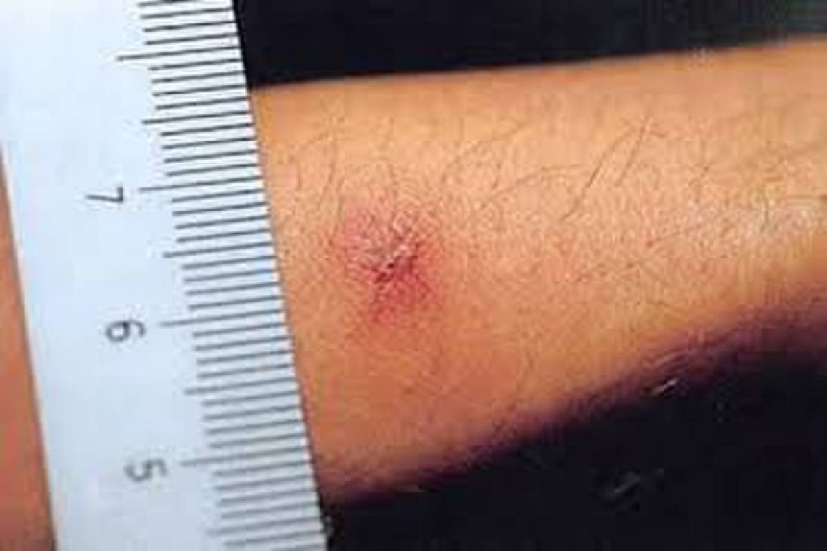 Eschar in the left arm of patient with scrub typhus