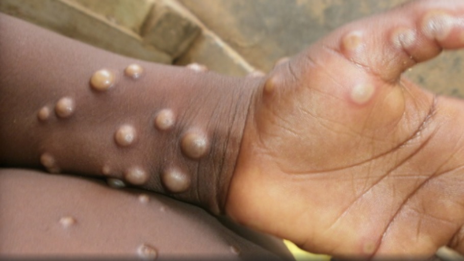 A Kerala man suspected to be infected from Monkepox dies on Saturday.