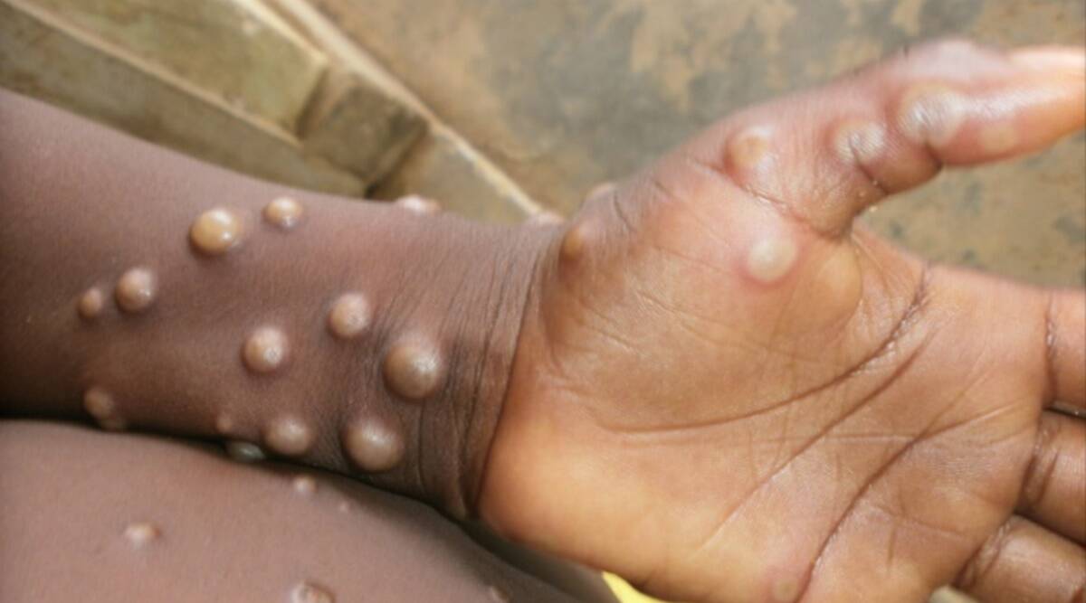 Second suspected Monkeypox detected in Kerala. (Representative Image/WHO)