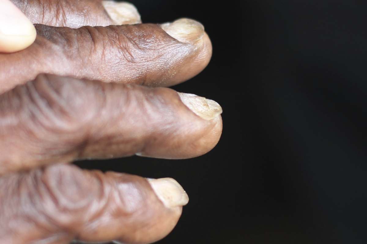 Anaemia
