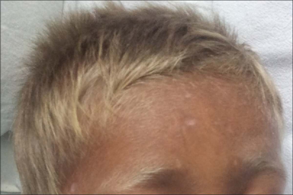 Griscelli Syndrome