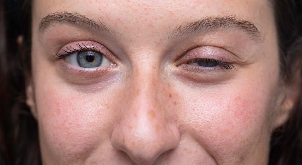 Myasthenia gravis is condition that weakens the voluntary muscles. (Representational picture/Wikimedia Commons)