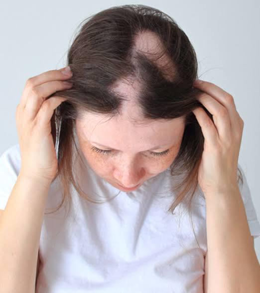 Representational impage of a patient with trichotillomania, where they pluck hair from parts of their body.