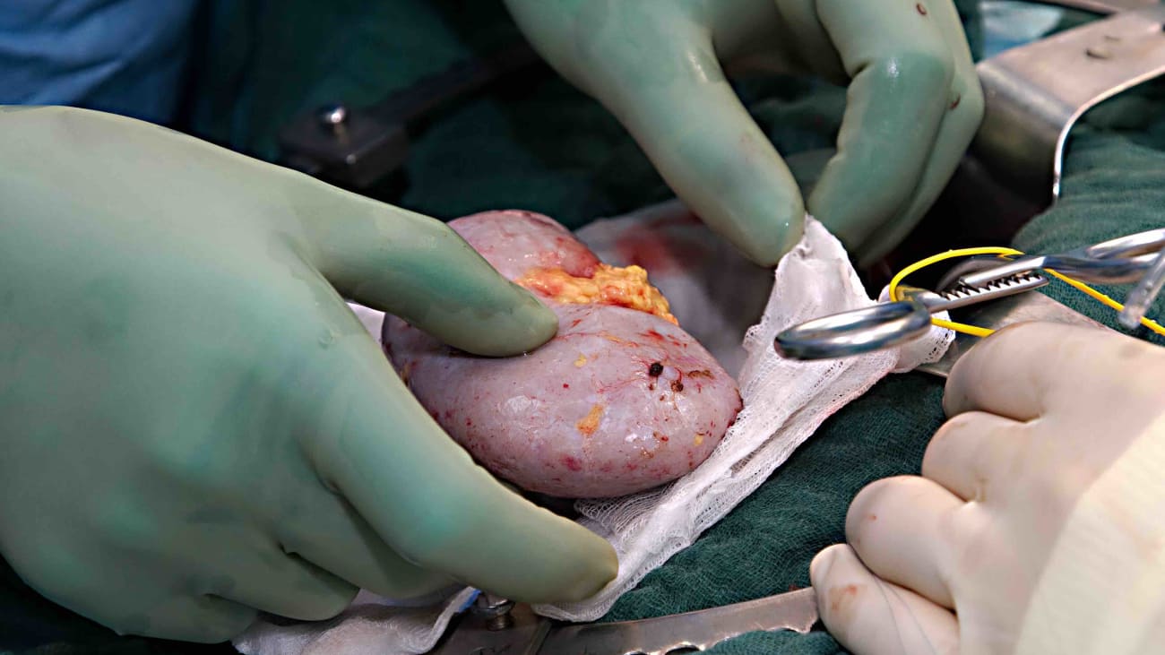 Representational pic of kidney surgery