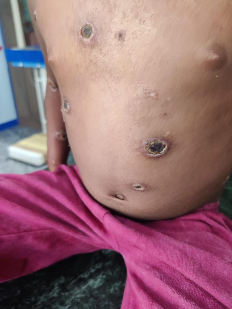 Chickenpox in Bengaluru