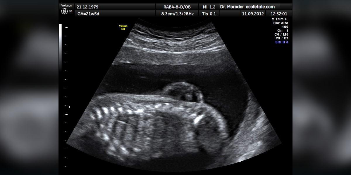Myelomeningocele in ultrasonography. (Wikimedia Commons)