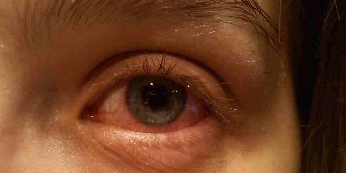 Doctors agree that there is no known correlation between the increased conjunctivitis cases and the new Covid-19 variant. (Creative Commons)