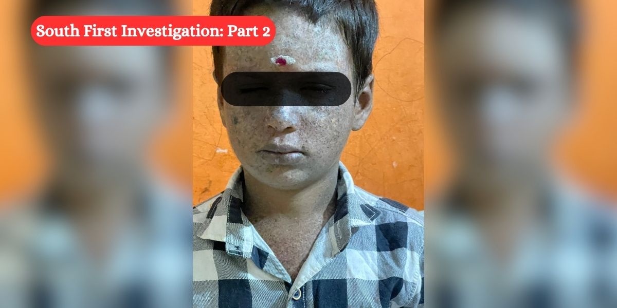 Xeroderma Pigmentosum: Parents helpless, doctors baffled as authorities remain blind to child-killing ‘chukki kayle’