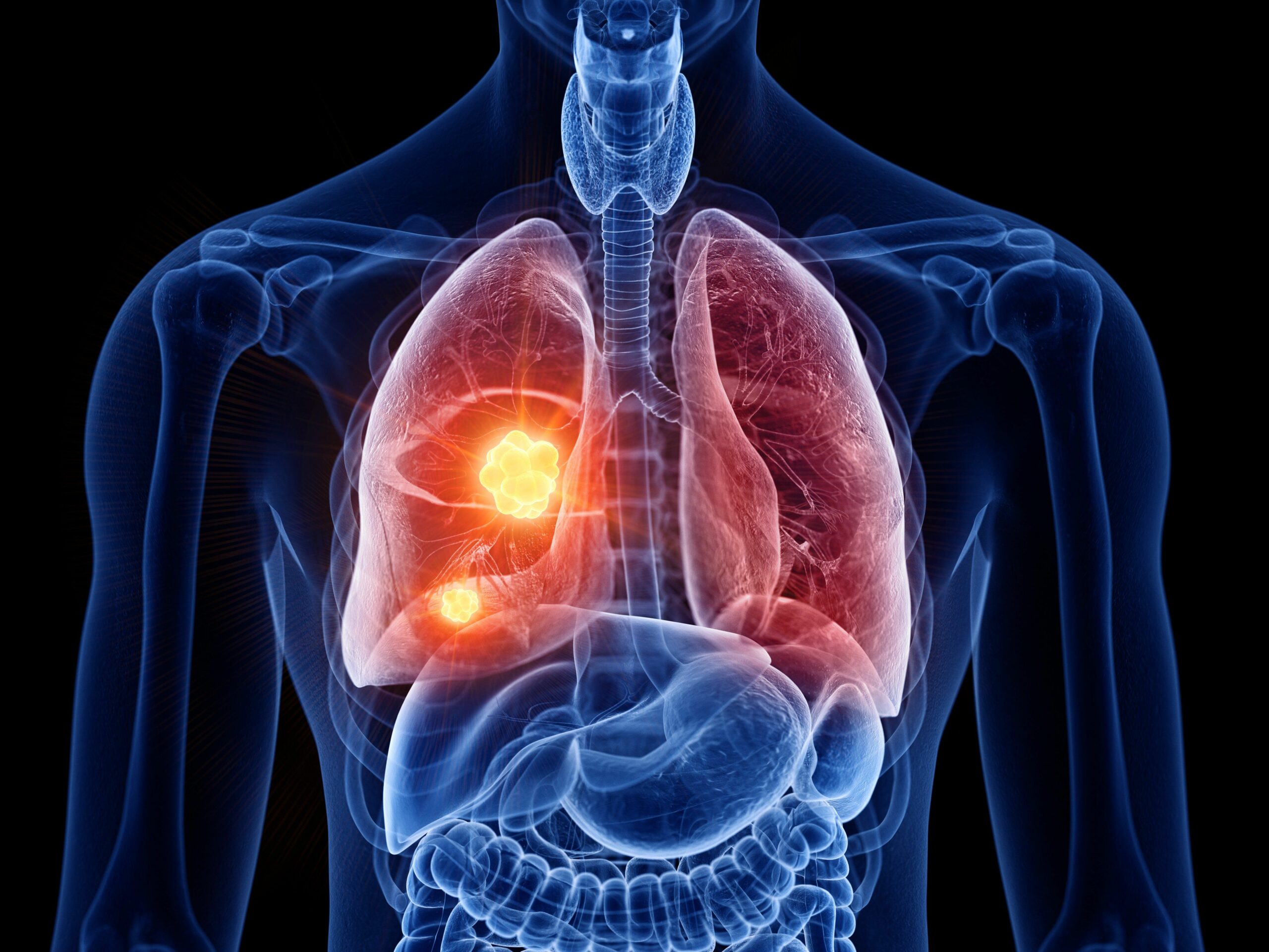 Doctors recommend seeking medical attention if one is experiencing prolonged lung symptoms like shortness of breath or coughing. (Creative Commons)