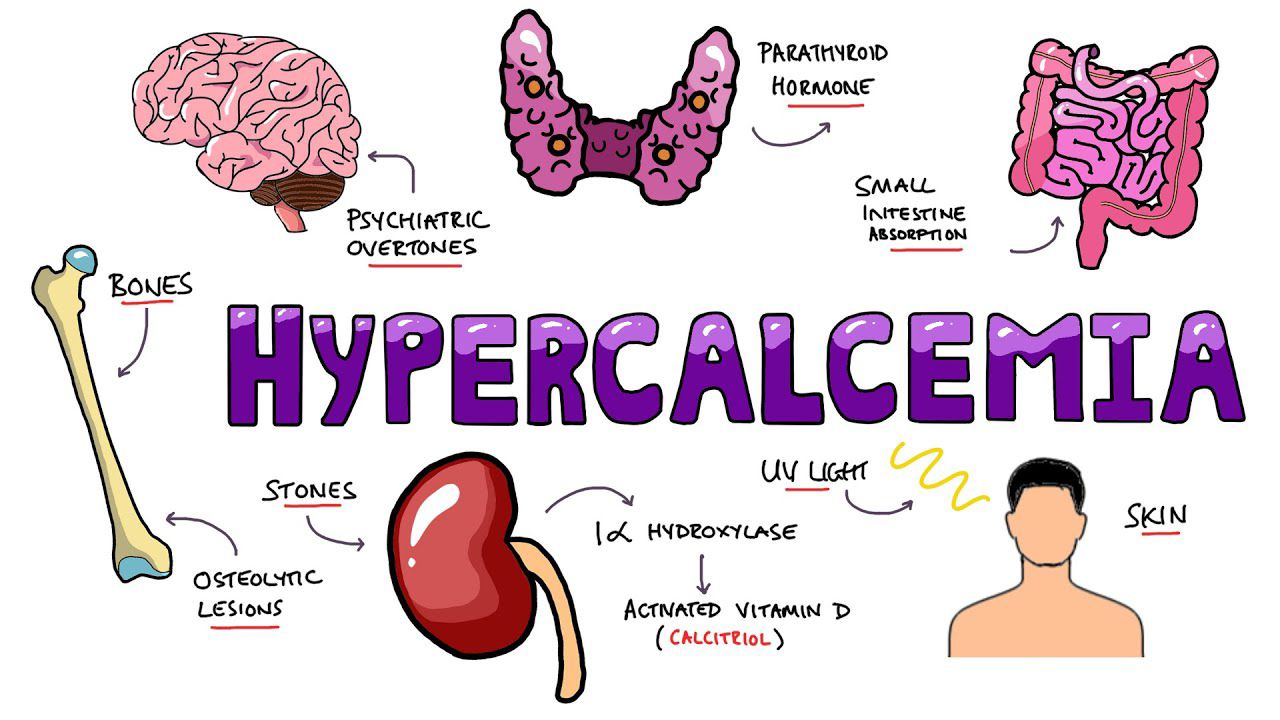 Hypercalcemia can cause a number of symptoms that affect various systems. (Rhesus Medicine/Supplied)