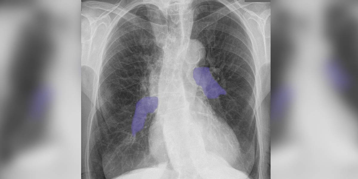 CTEPH is a condition in which permanent blood clots form in the major vessels leading from the heart to the lungs, causing heart failure. (Creative Commons)