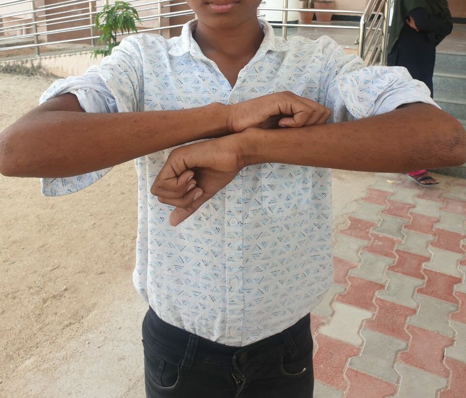 Child showing scabies rashes