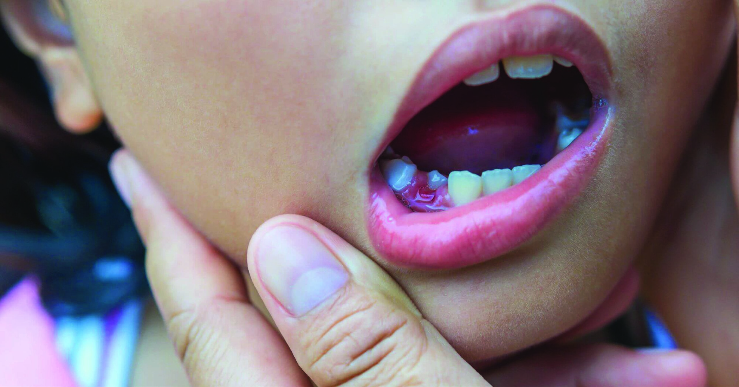 Pulpectomy or baby root canal may be necessary in cases where there is severe decay of the tooth. (Wikimedia Commons)