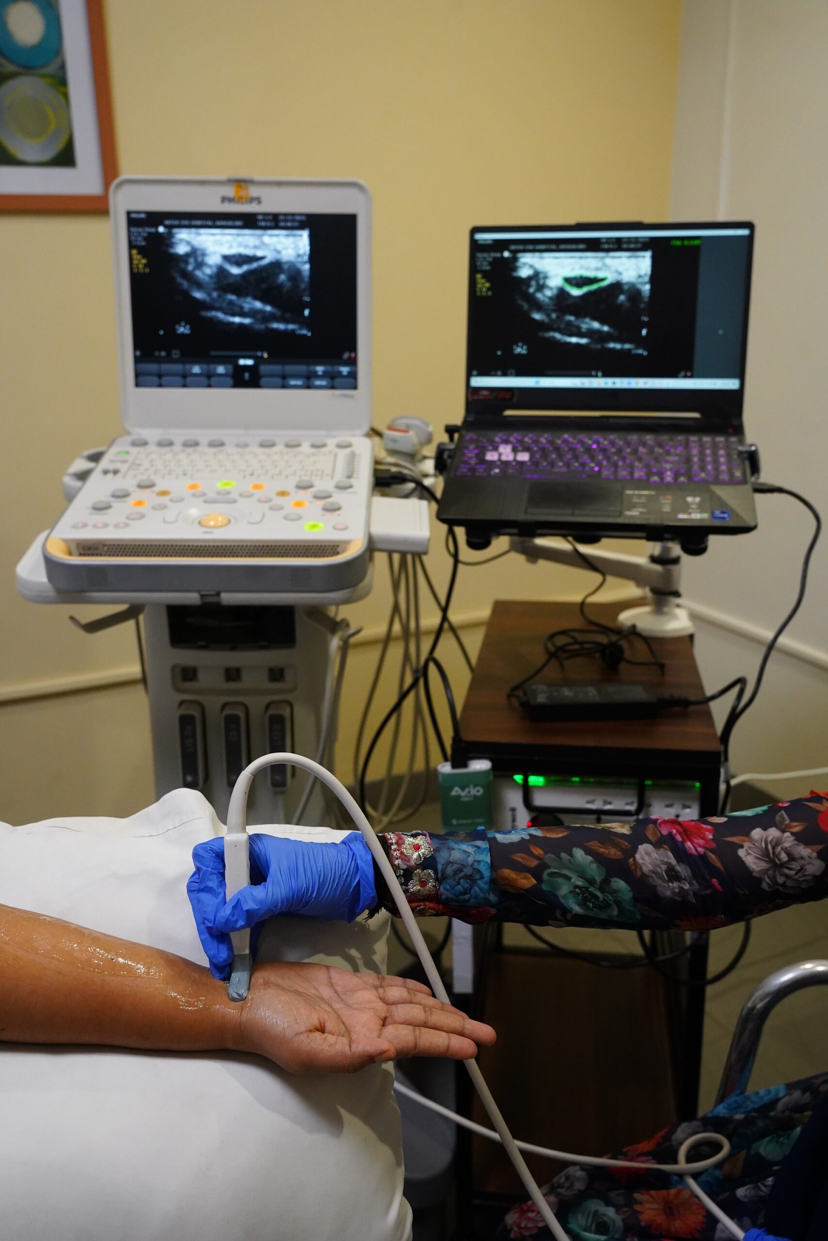 New AI tool to diagnose carpal tunnel syndrome. (Supplied)