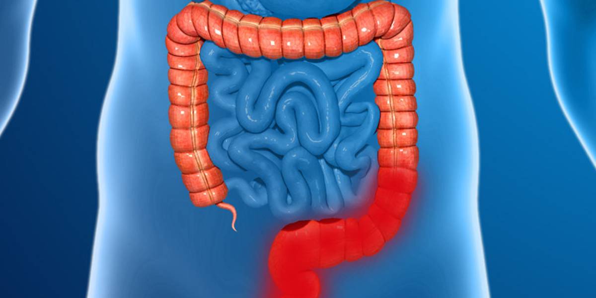 What is Inflammatory Bowel Disease? 5.4% of Telangana’s population suffers from this disease