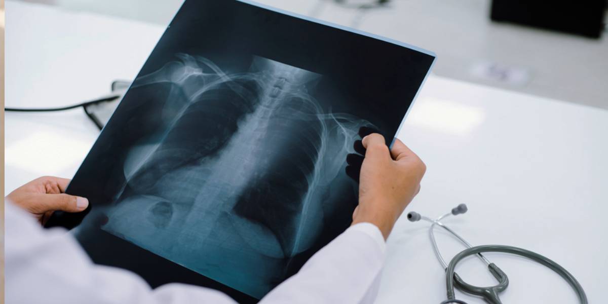 The study noticed a 3.9 percent increase in predicted DLCO over about 18 months. (Shutterstock)