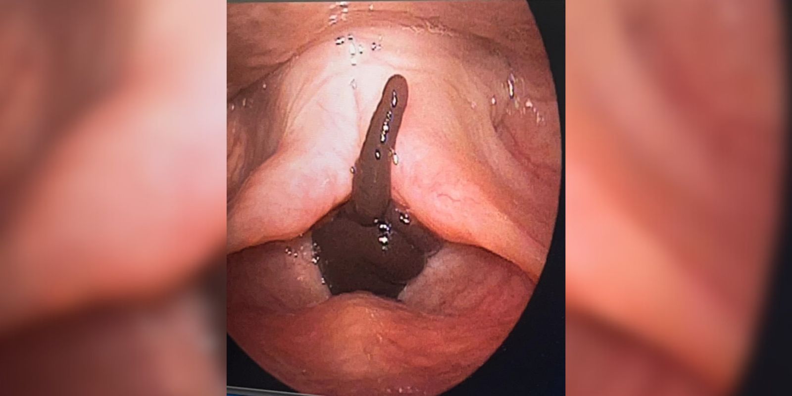 The live leech inside the woman's larynx.