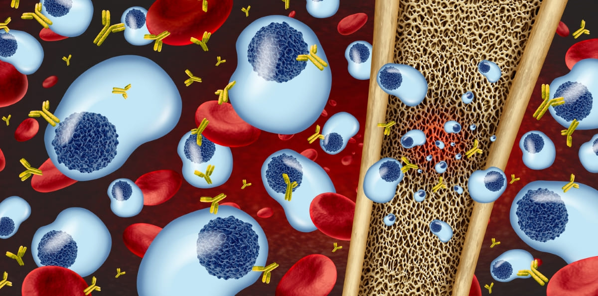 CAR-T cell therapy in multiple myeloma