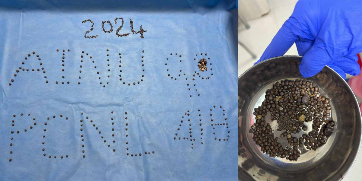418 stones removed from one patient. (Supplied)