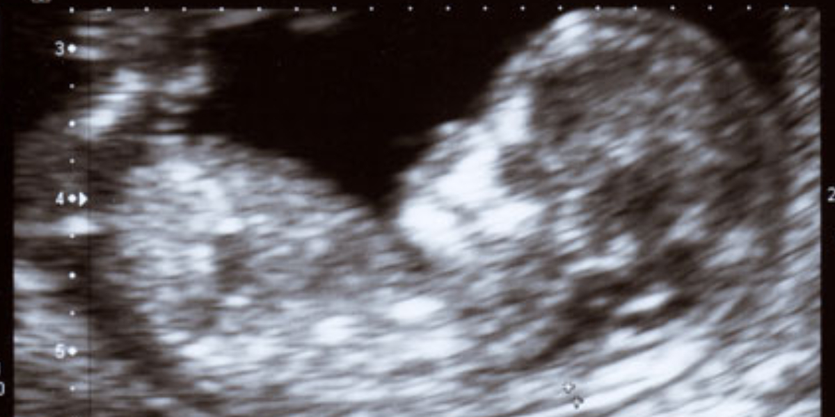 A mother’s 17-year-long legal battle: Kerala hospital, doctor ordered to pay ₹50 lakh for failing to detect abnormalities in foetus