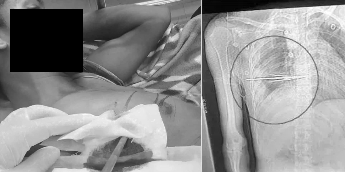 Arrow lodged in chest, tribal teen saved by Hyderabad doctors after 4 hours of surgery