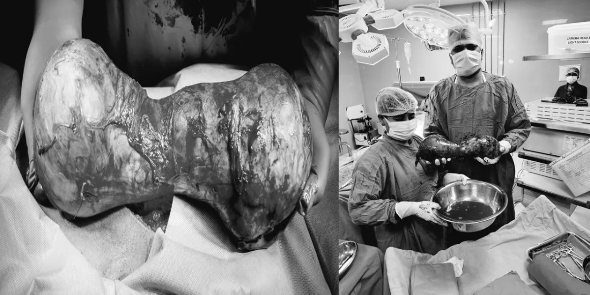 Hyderabad hospital successfully removes rare, giant dumbbell-shaped testis tumour from 39-year-old man