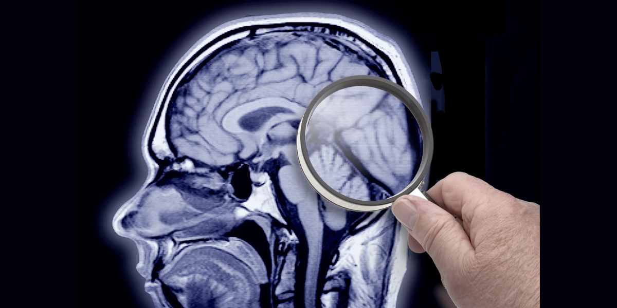 Alzheimer's