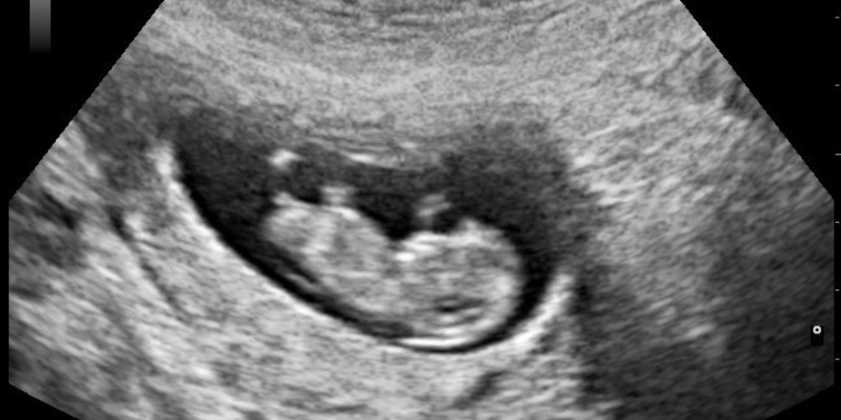 Illegal sex determination and botched abortion: How a Telangana family's desire for a son led to death of a pregnant woman