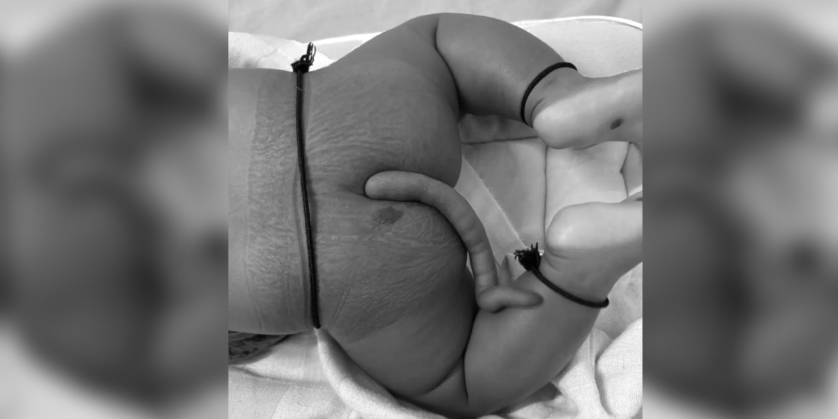 Doctors at AIIMS Bibinagar successfully removed human tail from an infant