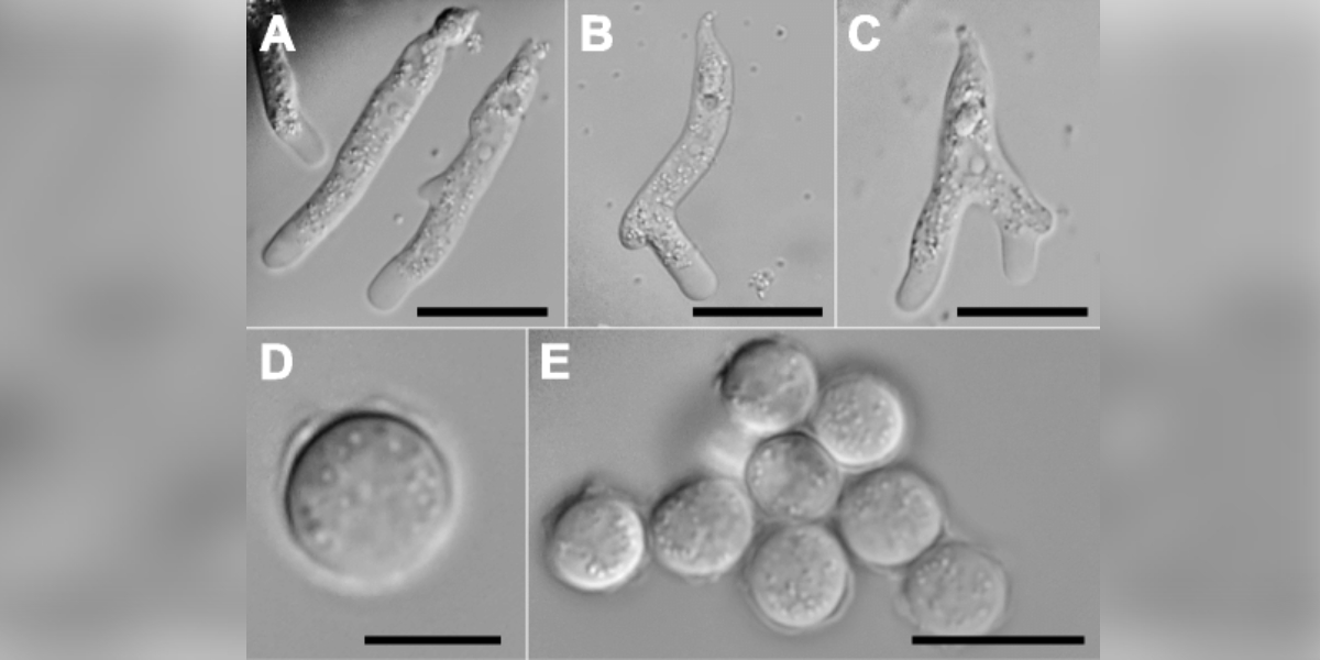 Amoebic Meningoencephalitis (PAM) and Vermamoeba vermiformis