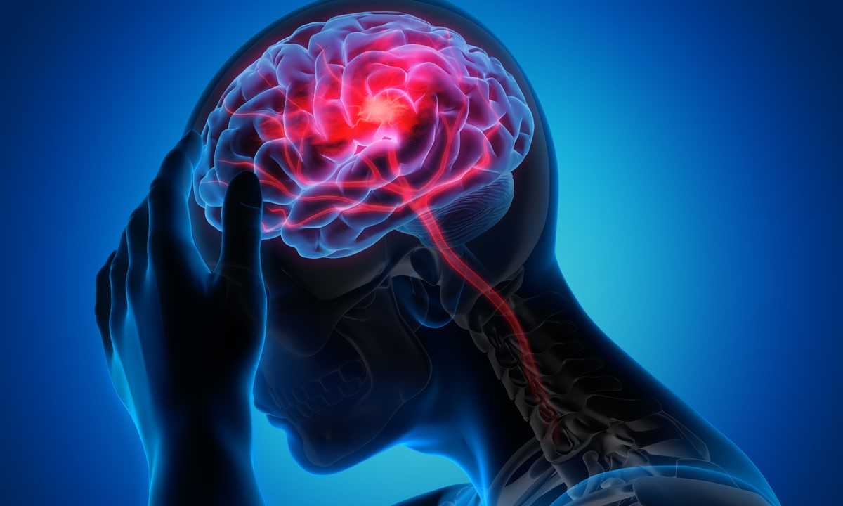 Brain stroke.