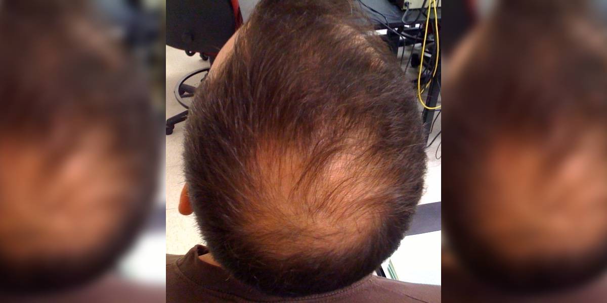Doctors feel more study on humans is necessary to establish the link between intermittent fasting and alopecia. (Wikimedia Commons)