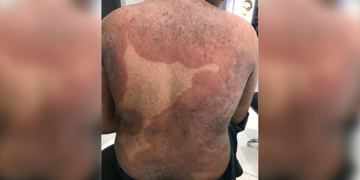 Why are experts frowning at the name of a skin fungus linked to India?