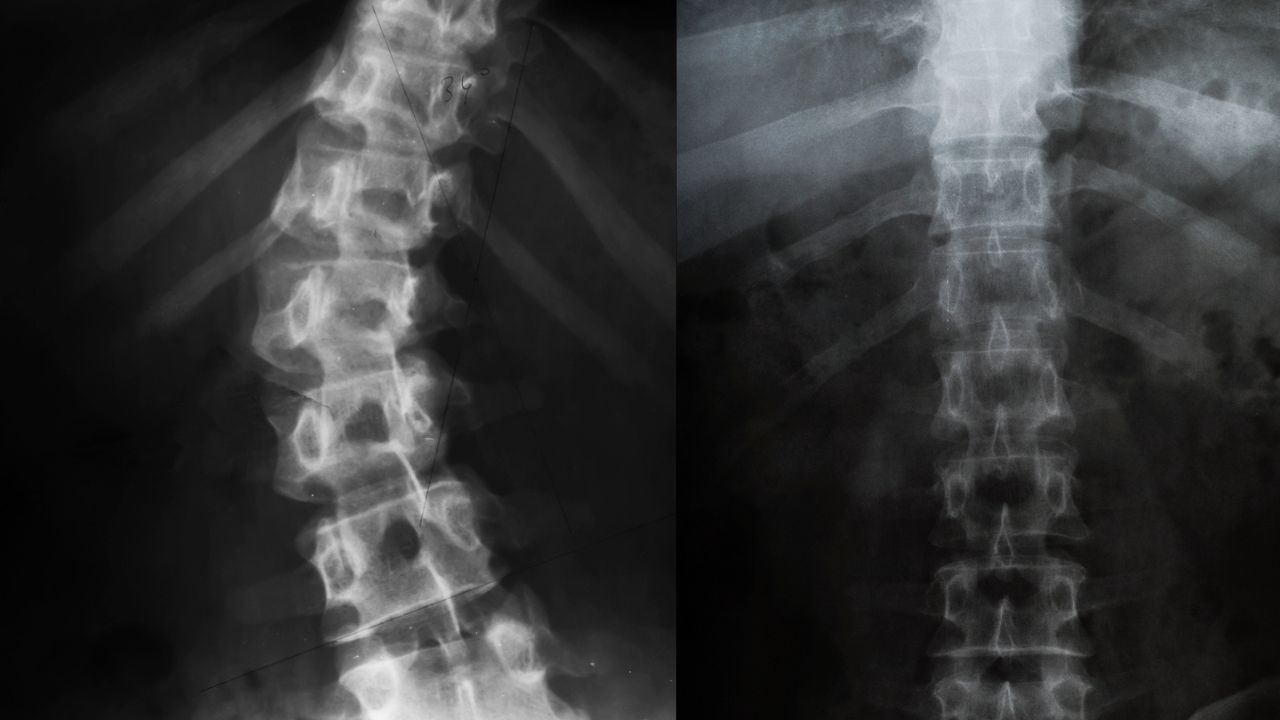 Karnataka adds corrective spine surgeries to Ayushman Bharat – Arogya Karnataka Yojana
