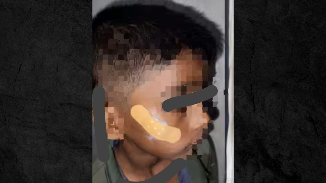 Karnataka nurse uses Feviquick to seal boy’s cheek wound instead of stitches