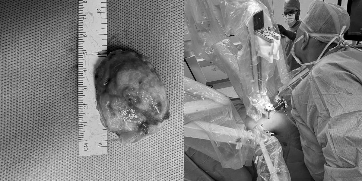 First robotic retroperitoneal partial nephrectomy in Telugu states