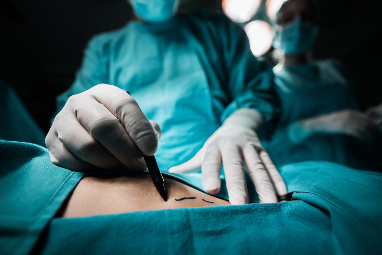Liposuction is a common cosmetic procedure. (iStock)
