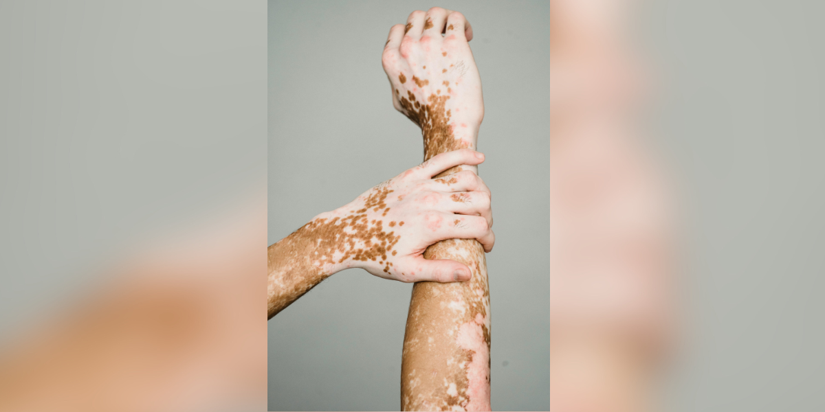 World Vitiligo Day: Yet another gut health win (Pexels- Armin Rimoldi)