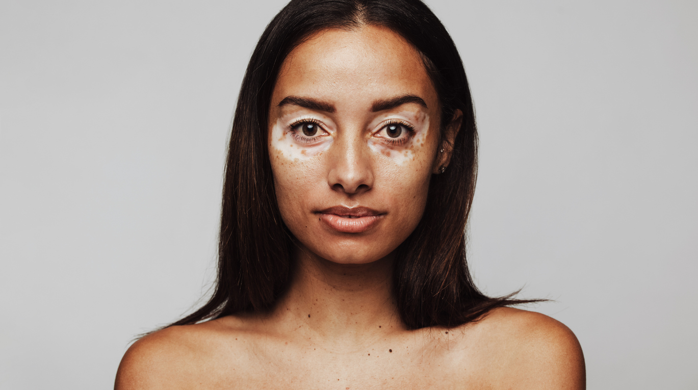 Vitiligo.