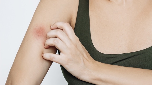 Candidiasis or yeast infection, frequently affect the skin, scalp, or nails.