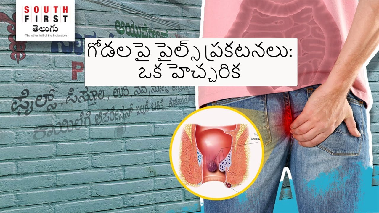 piles fistula ads