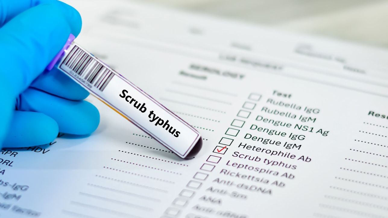 Scrub typhus test. (iStock)