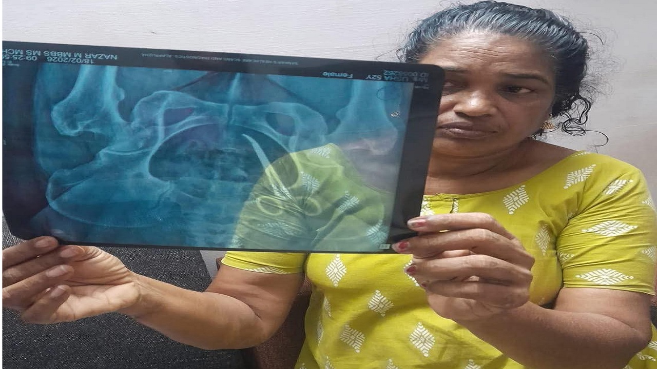 A case of suspected medical negligence has come to light after a surgical scissor was discovered inside the abdomen of a 51 year-old woman