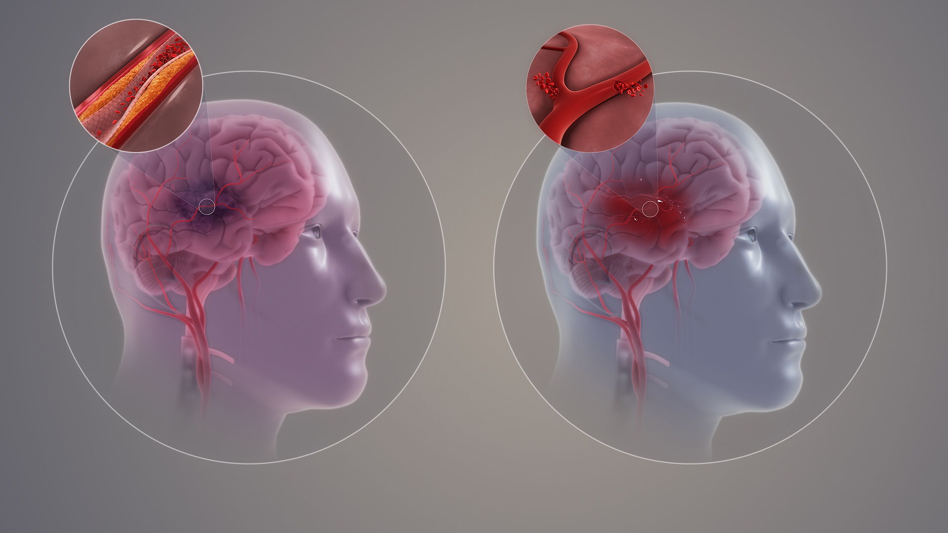 One in seven stroke patients in India is under 45, over half die: Study